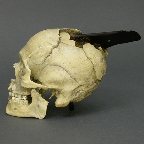 Spanish Conquistador Human Skull with Broad Ax Trauma - Bone