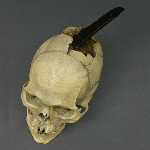 Spanish Conquistador Human Skull with Broad Ax Trauma - Bone